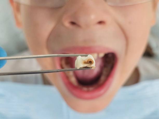 Best Emergency Treatment for Oral Infections in Mayo, SC
