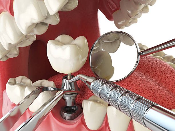 Best Broken or Chipped Tooth Repair in Mayo, SC